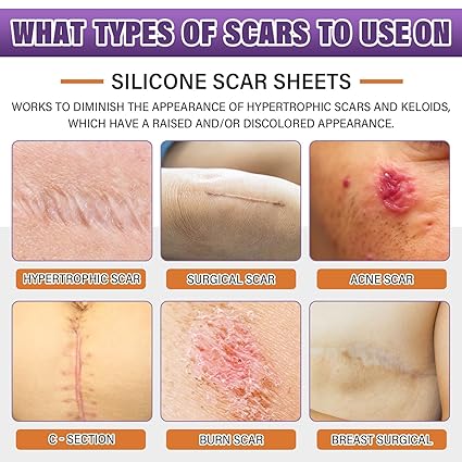 Silicone Scar Sheets,Silicone Scar Tape,Scar Tape For Surgical Scars,Silicone Scar Removal Strips For Surgical,C-Section,Tummy Tuck,Keloid Scars(1.6"X 59" Roll-1.5M) Keloid Bump Removal